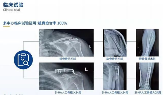 中国有五个,2022全球骨科器械十大事件