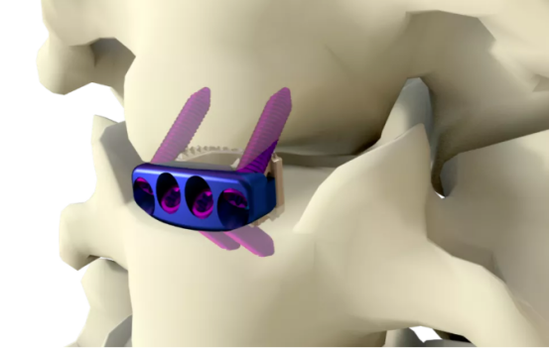 中国有五个,2022全球骨科器械十大事件